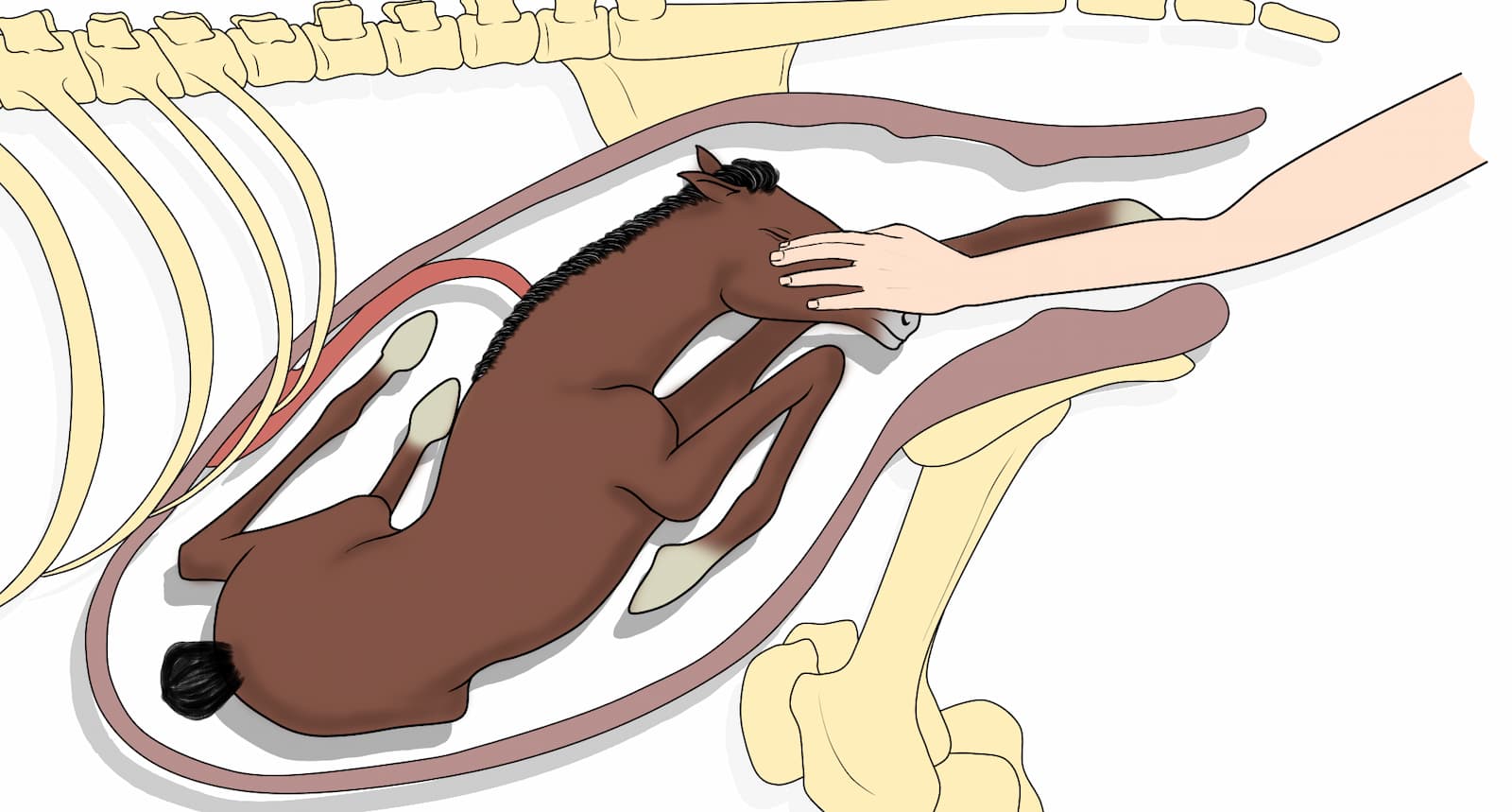 Ilustración de una cesárea que muestra la incisión realizada en el